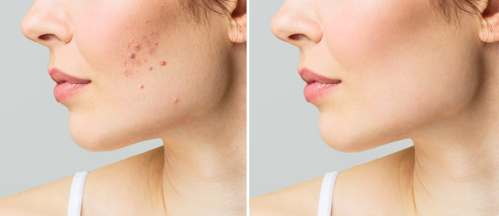 Understanding Acne: Causes, Treatments, and Prevention