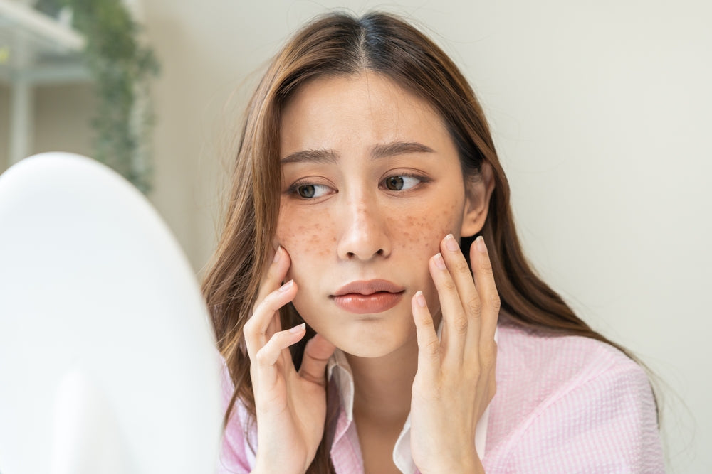 Getting to Know Melasma: What's Causing Those Brown Patches?